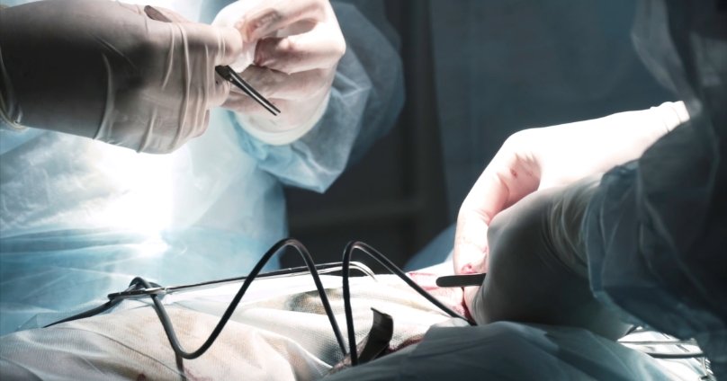 Bleeder Embolization