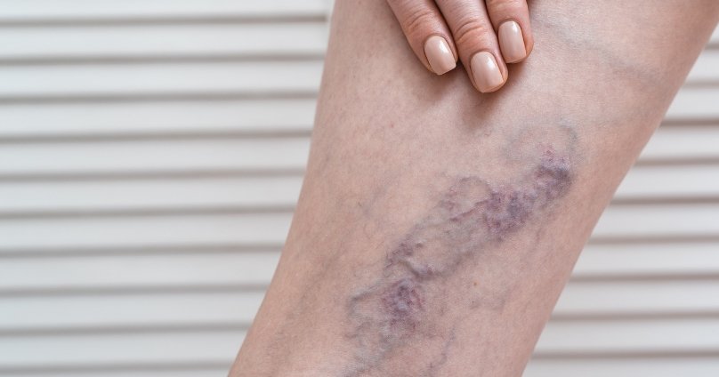 Deep Vein Thrombosis Treatment