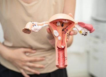 Uterine Artery Embolization