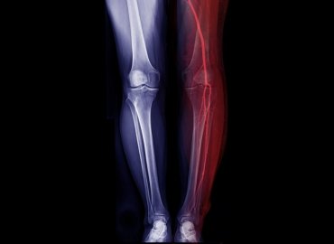 GAE for Osteoarthritis